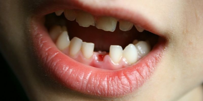 Mơ Thấy Rụng Răng Đánh Gì? Jun88 Hé Lộ Bộ Số Vàng 2025 6 Mơ rụng răng ra máu nhưng tiền chảy thành dòng – điềm bù đắp hoàn hảo